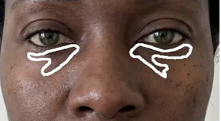 Dark circles on one test face: expert annotation, then Haut.AI, Gemini 3.5 Flash, GPT-5.6 Sol, Claude Fable 5, Grok 4.6, Qwen3.8 27B, MedGemma 27B.
