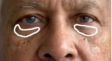 Eye puffiness on one test face: expert annotation, then Haut.AI, Gemini 3.5 Flash, Claude Fable 5, Grok 4.6, Qwen3.8 27B, GPT-5.6 Sol, MedGemma 27B.
