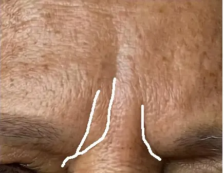 Frown lines on one test face: expert annotation, then Haut.AI, Gemini 3.5 Flash, GPT-5.6 Sol, Claude Fable 5, Qwen3.8 27B, Grok 4.6, MedGemma 27B.