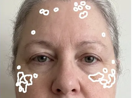 Sun spots on one test face: expert annotation, then Haut.AI, Claude Fable 5, GPT-5.6 Sol, Gemini 3.5 Flash, Grok 4.6, Qwen3.8 27B, MedGemma 27B.